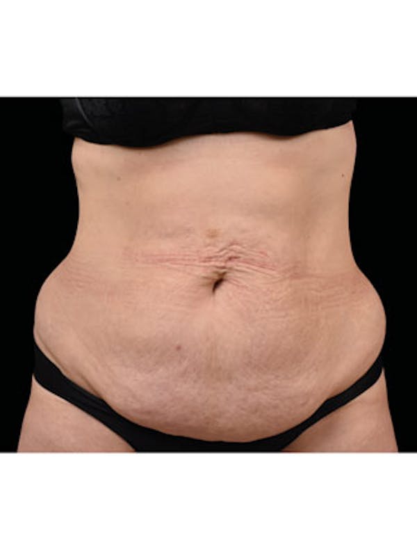 Emsculpt Neo Before & After Gallery - Patient 25139480 - Image 1
