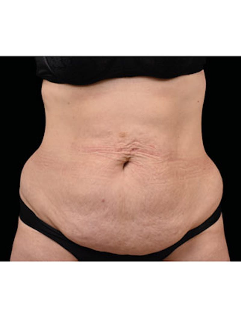 Emsculpt Neo Before & After Gallery - Patient 25139480 - Image 1