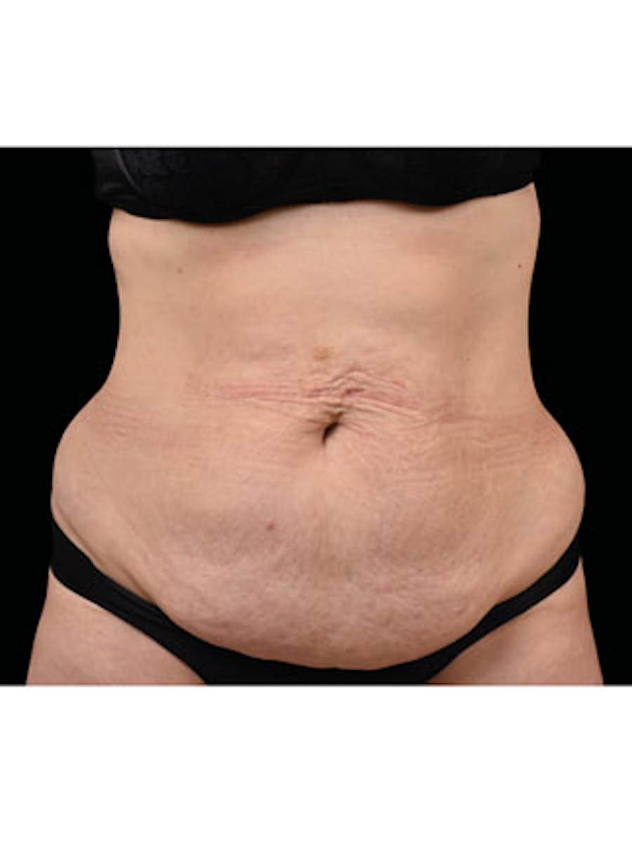 Emsculpt Neo Before & After Gallery - Patient 25139480 - Image 1
