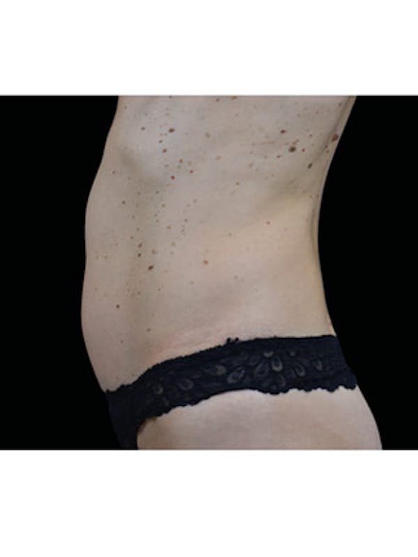 Emsculpt Neo Before & After Gallery - Patient 25139503 - Image 1