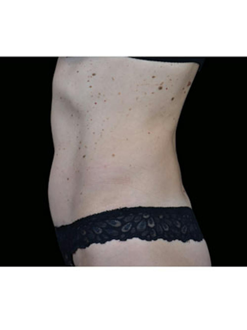 Emsculpt Neo Before & After Gallery - Patient 25139503 - Image 2