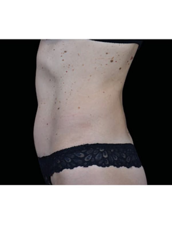 Emsculpt Neo Before & After Gallery - Patient 25139503 - Image 2