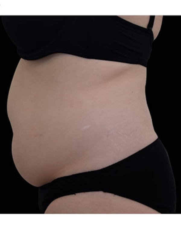 Emsculpt Neo Before & After Gallery - Patient 25139531 - Image 1