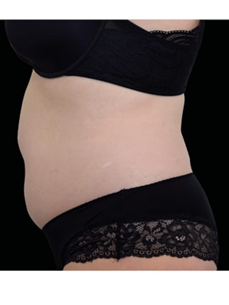 Emsculpt Neo Before & After Gallery - Patient 25139531 - Image 2