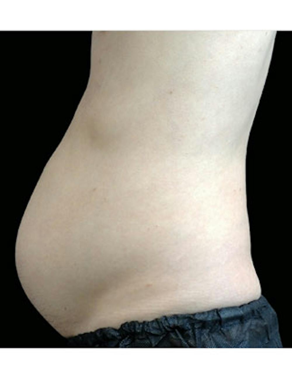 Emsculpt Neo Before & After Gallery - Patient 25139532 - Image 1