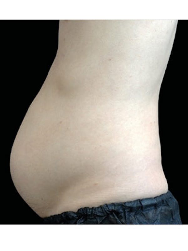 Emsculpt Neo Before & After Gallery - Patient 25139532 - Image 1