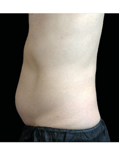 Emsculpt Neo Before & After Gallery - Patient 25139532 - Image 2