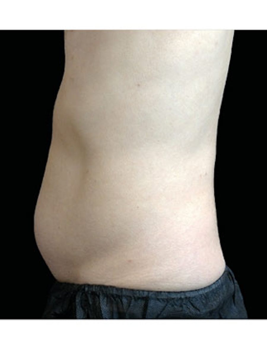 Emsculpt Neo Before & After Gallery - Patient 25139532 - Image 2