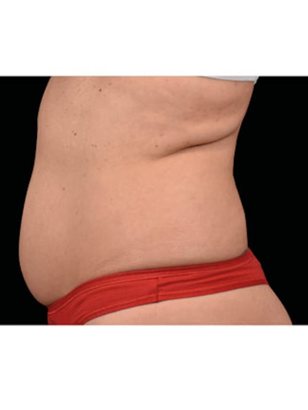 Emsculpt Neo Before & After Gallery - Patient 25139533 - Image 1