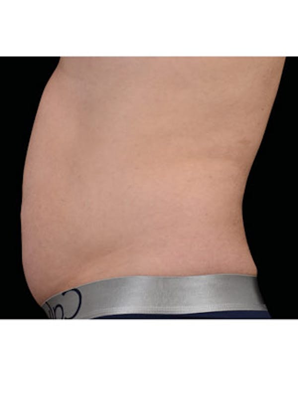 Emsculpt Neo Before & After Gallery - Patient 25139534 - Image 1