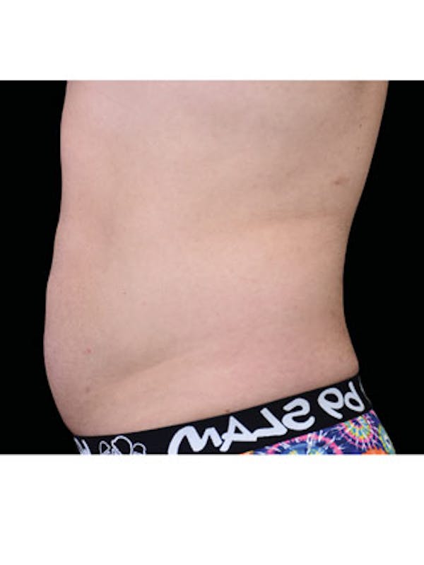 Emsculpt Before & After Gallery - Patient 25139534 - Image 2