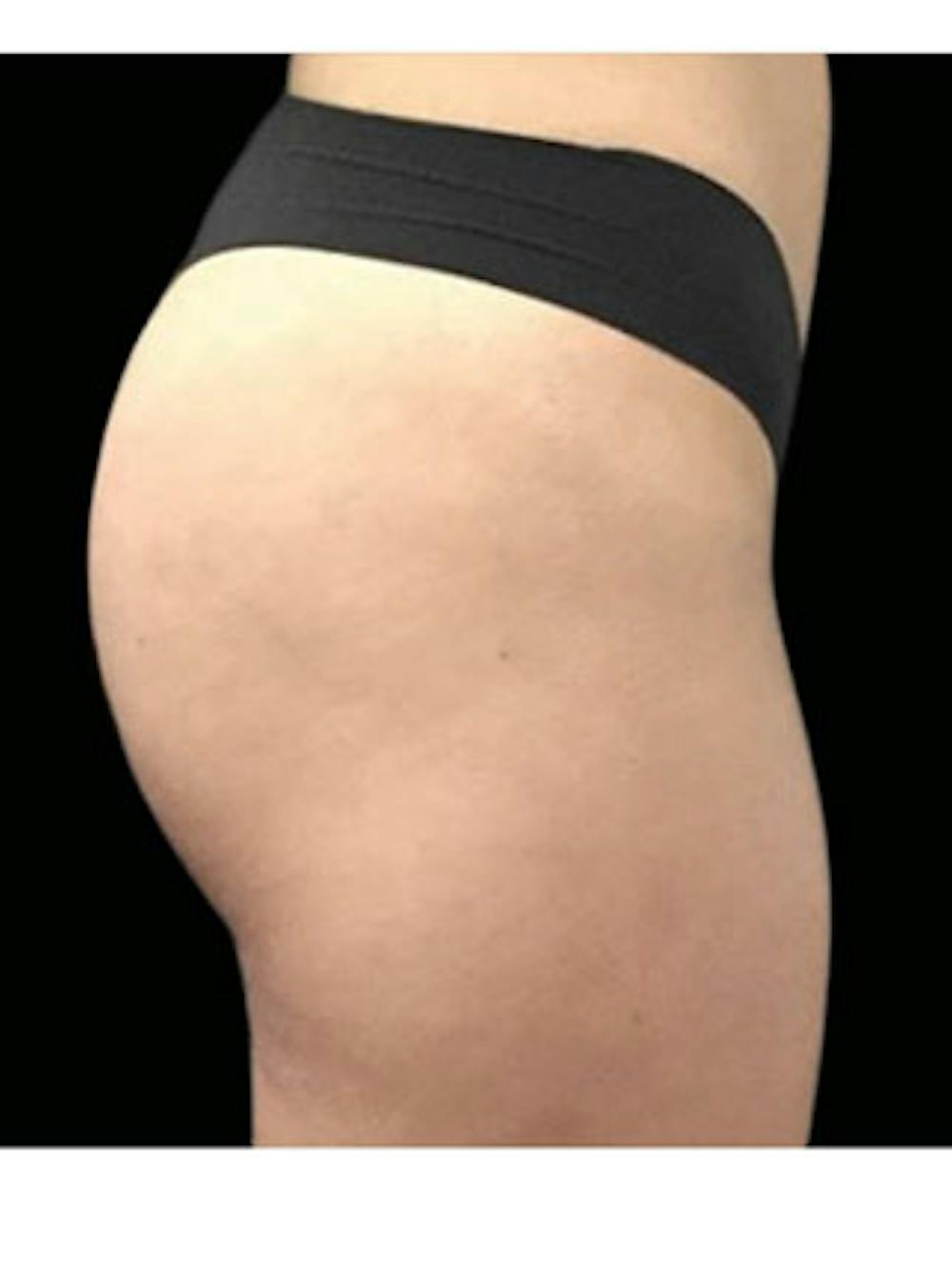 Emsculpt Neo Before & After Gallery - Patient 25139548 - Image 1