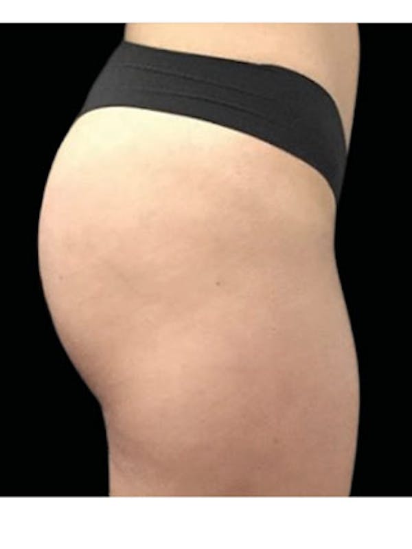 Emsculpt Neo Before & After Gallery - Patient 25139548 - Image 1