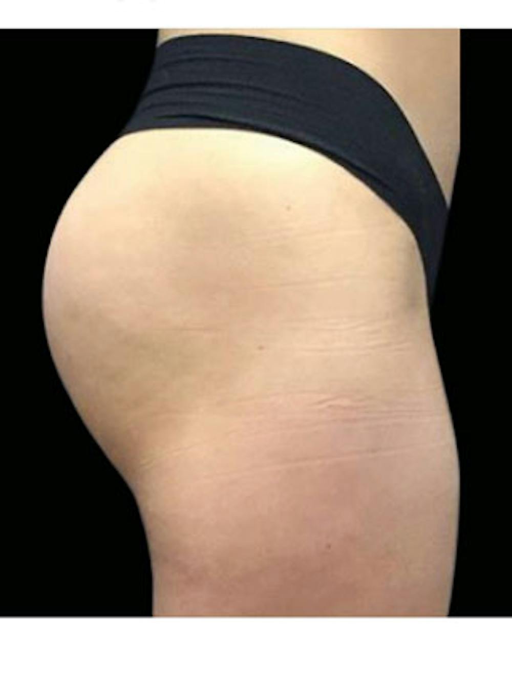 Emsculpt Neo Before & After Gallery - Patient 25139548 - Image 2