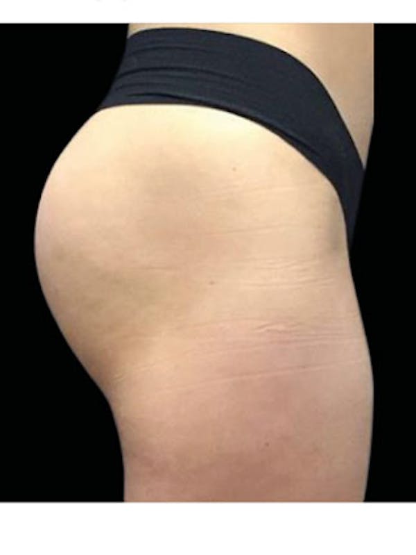 Emsculpt Neo Before & After Gallery - Patient 25139548 - Image 2