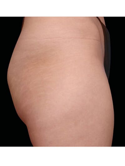 Emsculpt Before & After Gallery - Patient 25139555 - Image 1