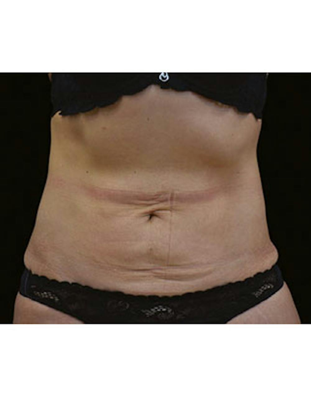 Emsculpt Neo Before & After Gallery - Patient 25139569 - Image 1