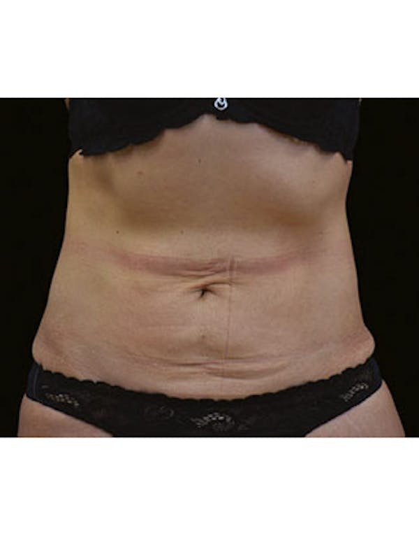 Emsculpt Neo Before & After Gallery - Patient 25139569 - Image 1