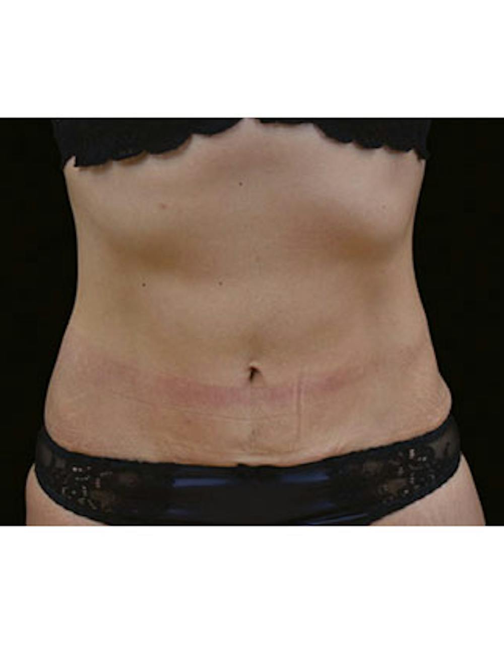 Emsculpt Neo Before & After Gallery - Patient 25139569 - Image 2