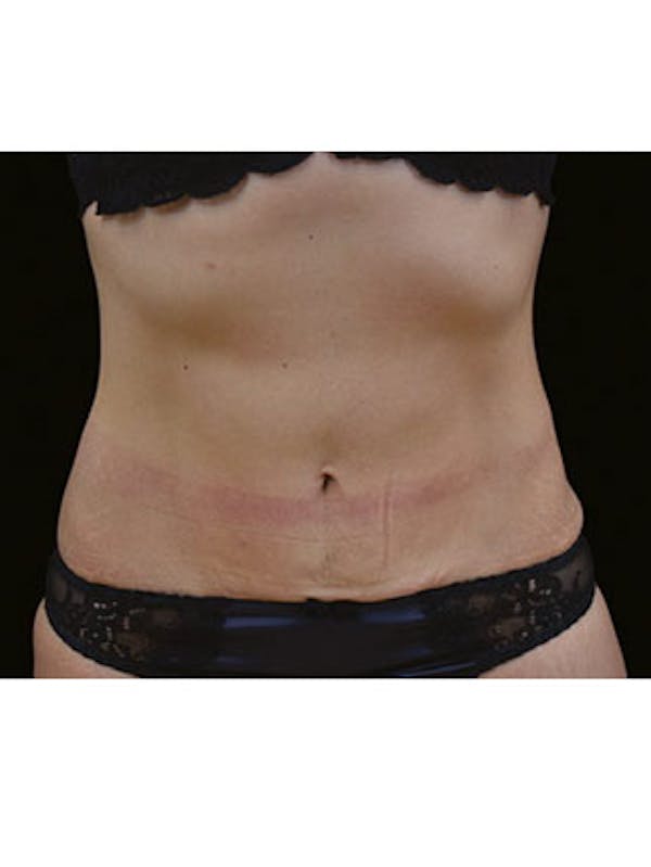 Emsculpt Neo Before & After Gallery - Patient 25139569 - Image 2