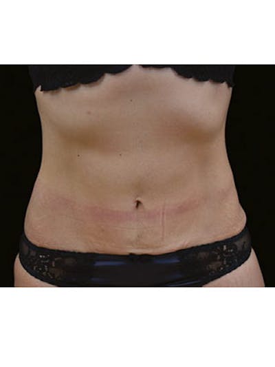 Emsculpt Before & After Gallery - Patient 25139569 - Image 2