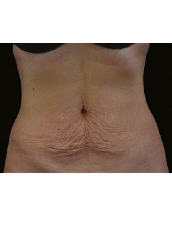Emsculpt Neo Before & After Gallery - Patient 25139591 - Image 1