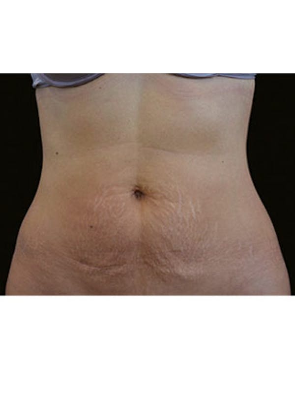 Emsculpt Neo Before & After Gallery - Patient 25139591 - Image 2