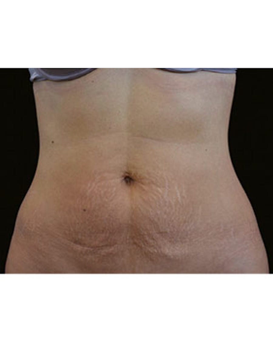 Emsculpt Neo Before & After Gallery - Patient 25139591 - Image 2