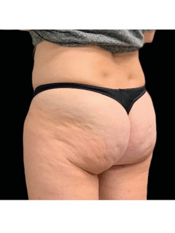 Emsculpt Before & After Gallery - Patient 25139593 - Image 1