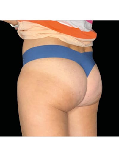 Emsculpt Neo Before & After Gallery - Patient 25139593 - Image 2