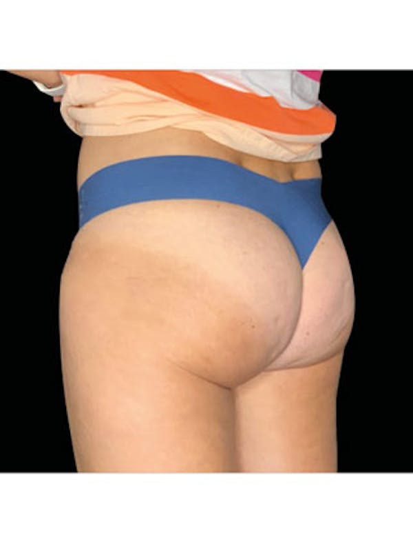 Emsculpt Before & After Gallery - Patient 25139593 - Image 2
