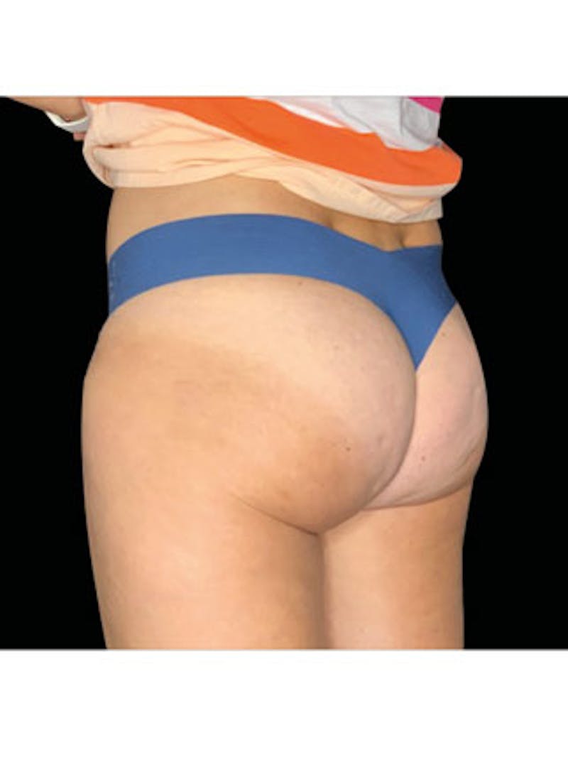 Emsculpt Neo Before & After Gallery - Patient 25139593 - Image 2