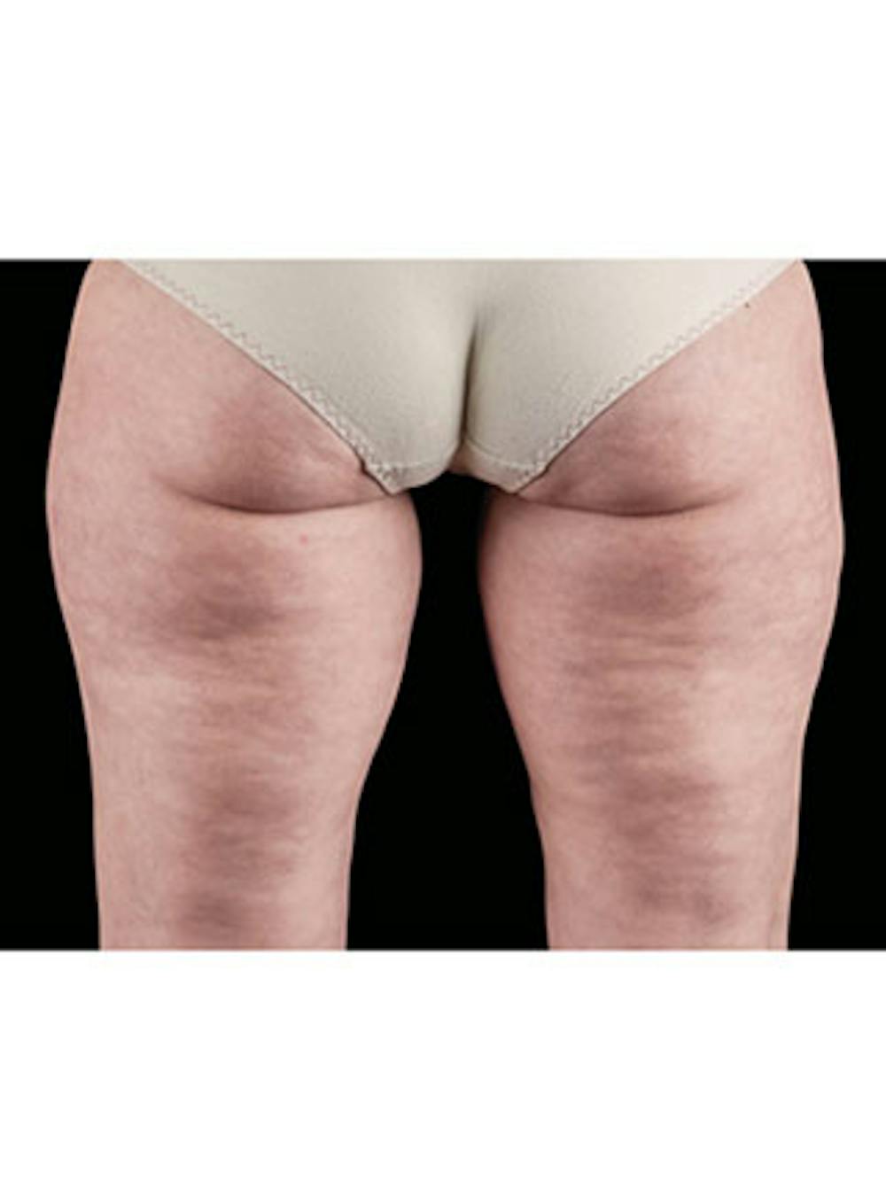 Emsculpt Neo Before & After Gallery - Patient 25139595 - Image 1