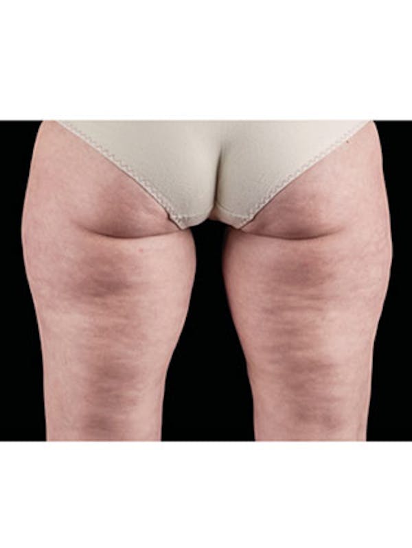 Emsculpt Neo Before & After Gallery - Patient 25139595 - Image 1