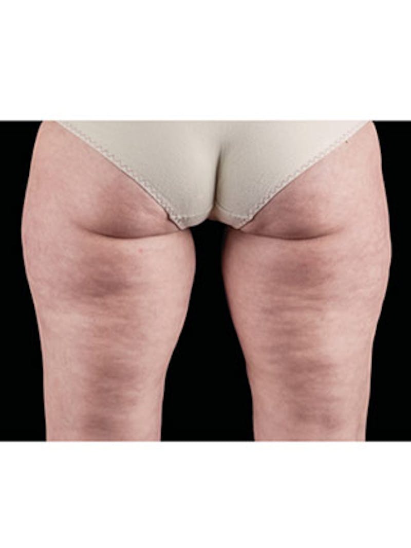 Emsculpt Neo Before & After Gallery - Patient 25139595 - Image 1