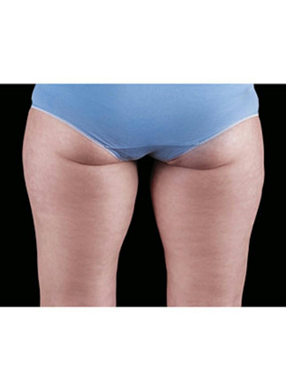 Emsculpt Neo Before & After Gallery - Patient 25139595 - Image 2