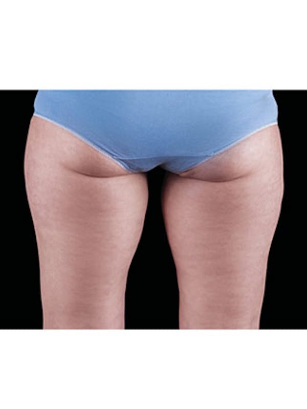 Emsculpt Neo Before & After Gallery - Patient 25139595 - Image 2