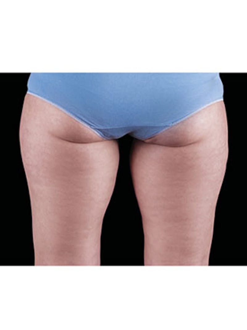 Emsculpt Neo Before & After Gallery - Patient 25139595 - Image 2