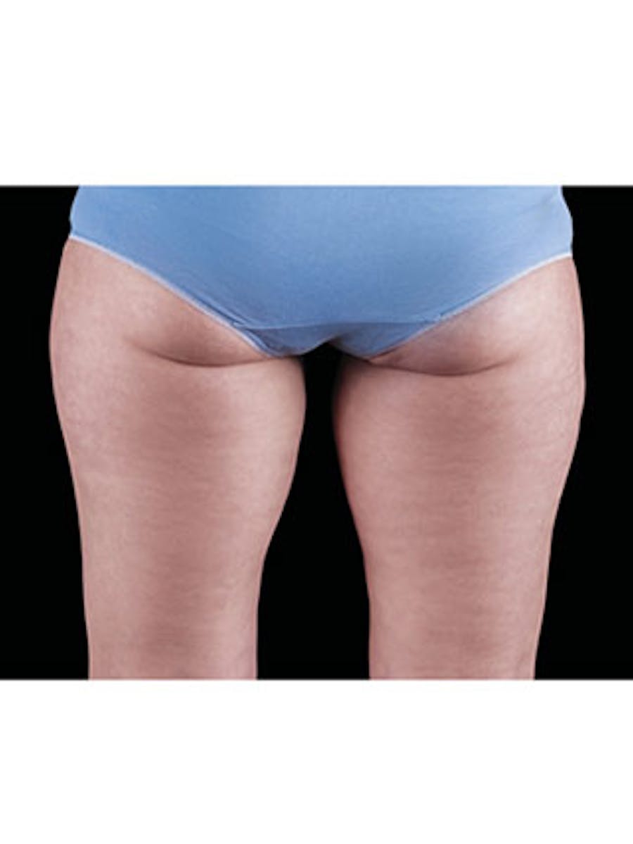 Emsculpt Neo Before & After Gallery - Patient 25139595 - Image 2