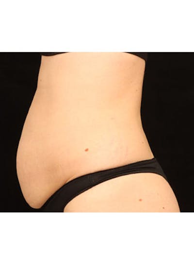 Emsculpt Neo Before & After Gallery - Patient 25139596 - Image 1