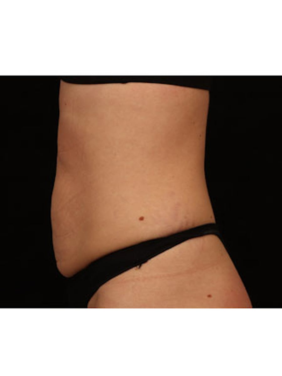 Emsculpt Neo Before & After Gallery - Patient 25139596 - Image 2