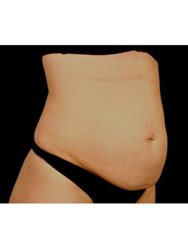 Emsculpt Neo Before & After Gallery - Patient 25139598 - Image 1