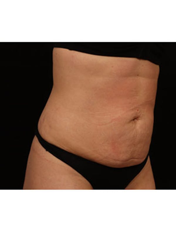 Emsculpt Neo Before & After Gallery - Patient 25139598 - Image 2