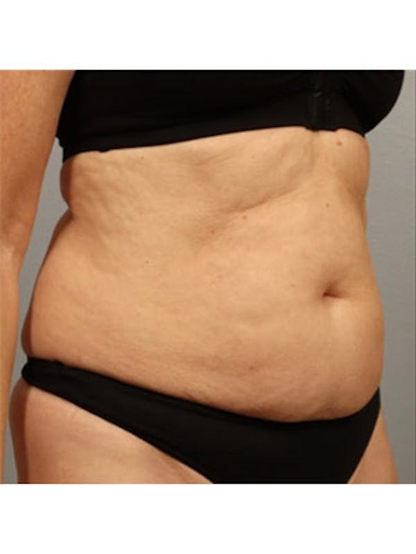 Emsculpt Neo Before & After Gallery - Patient 25139600 - Image 1