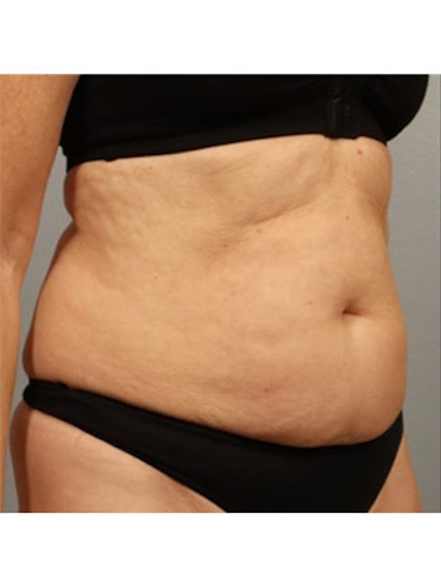 Emsculpt Neo Before & After Gallery - Patient 25139600 - Image 1