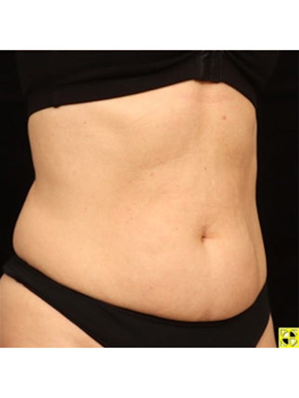 Emsculpt Neo Before & After Gallery - Patient 25139600 - Image 2
