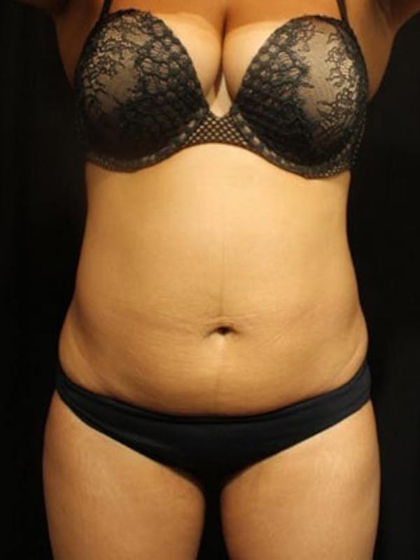 Emsculpt Neo Before & After Gallery - Patient 25139618 - Image 1