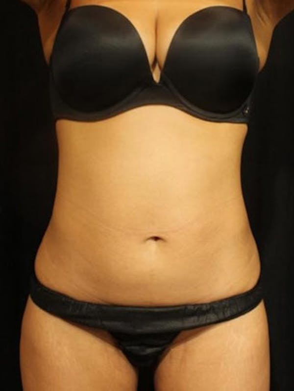 Emsculpt Neo Before & After Gallery - Patient 25139618 - Image 2