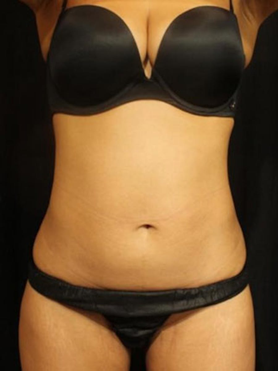 Emsculpt Neo Before & After Gallery - Patient 25139618 - Image 2