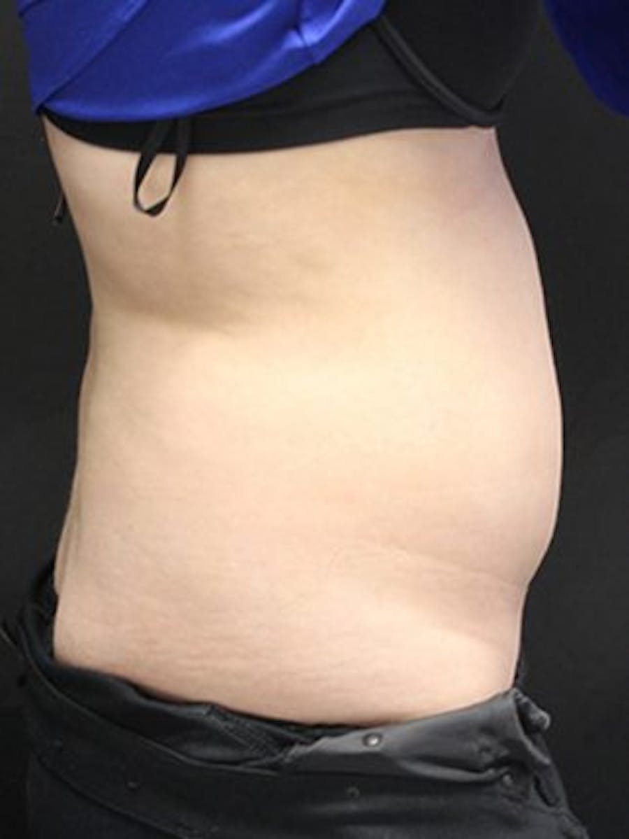 Emsculpt Neo Before & After Gallery - Patient 25139625 - Image 1